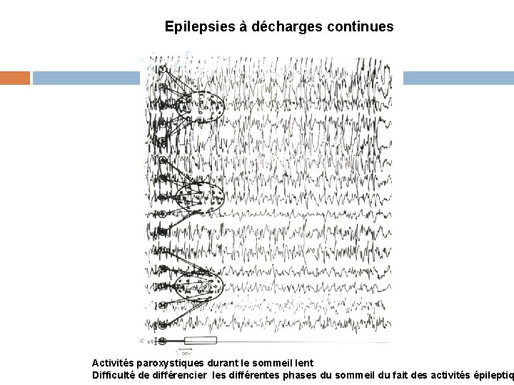 Epilepsies à décharges continues Activités paroxystiques durant le sommeil lent Difficulté de différencier les