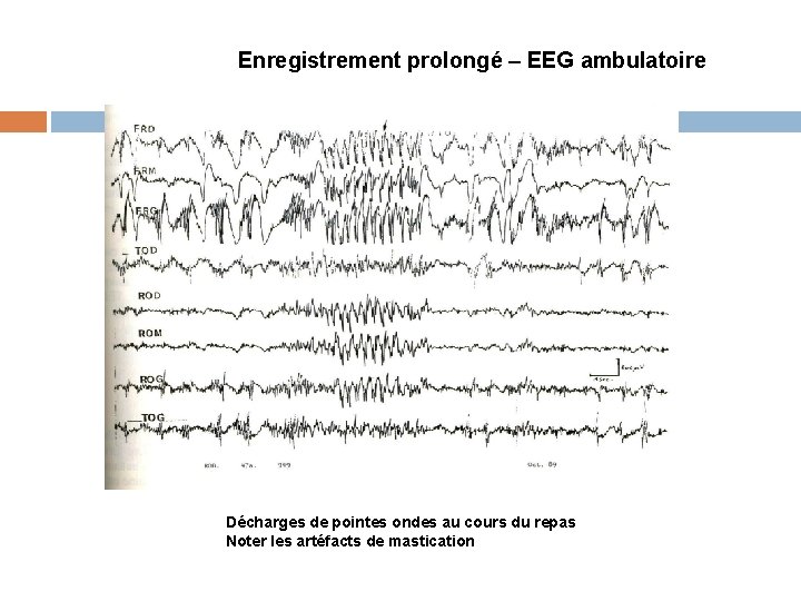 Enregistrement prolongé – EEG ambulatoire Décharges de pointes ondes au cours du repas Noter