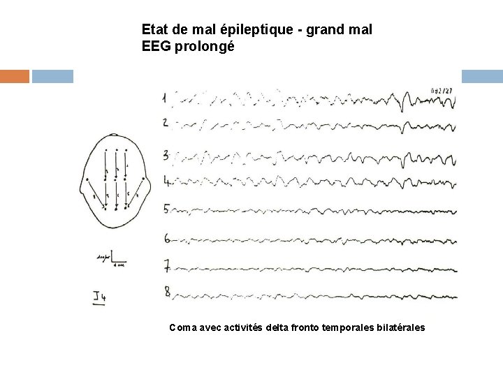 Etat de mal épileptique - grand mal EEG prolongé Coma avec activités delta fronto