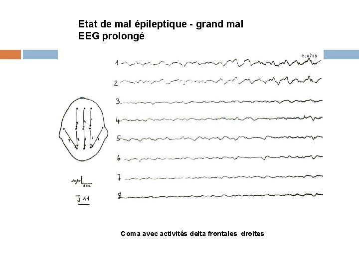 Etat de mal épileptique - grand mal EEG prolongé Coma avec activités delta frontales