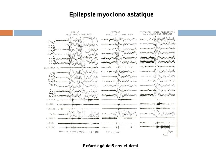 Epilepsie myoclono astatique Enfant âgé de 5 ans et demi 