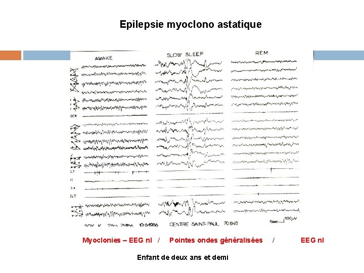 Epilepsie myoclono astatique Myoclonies – EEG nl / Pointes ondes généralisées Enfant de deux