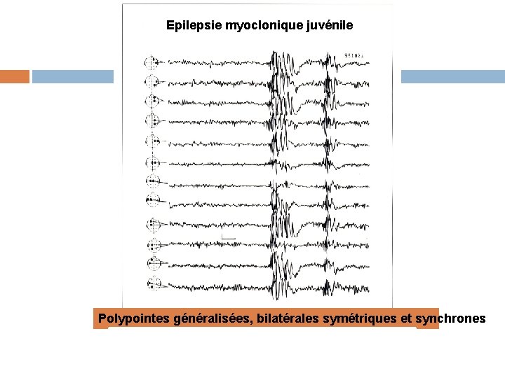 Epilepsie myoclonique juvénile Polypointes généralisées, bilatérales symétriques et synchrones 