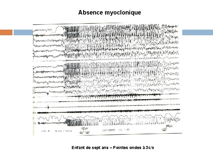 Absence myoclonique Enfant de sept ans – Pointes ondes à 3 c/s 