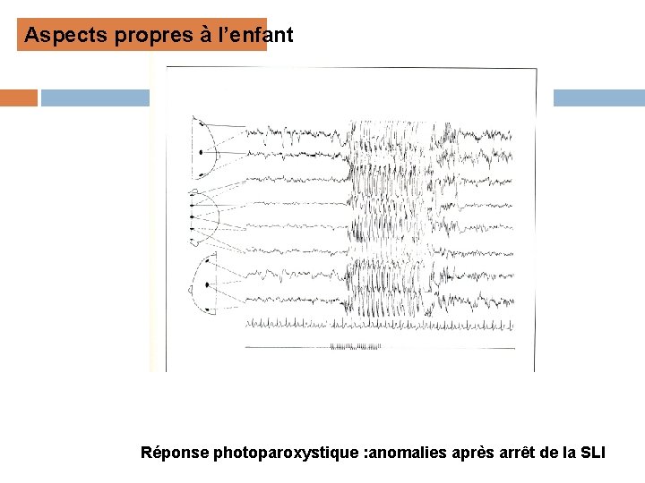 Aspects propres à l’enfant Réponse photoparoxystique : anomalies après arrêt de la SLI 