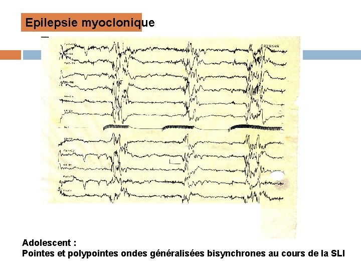 Epilepsie myoclonique Adolescent : Pointes et polypointes ondes généralisées bisynchrones au cours de la