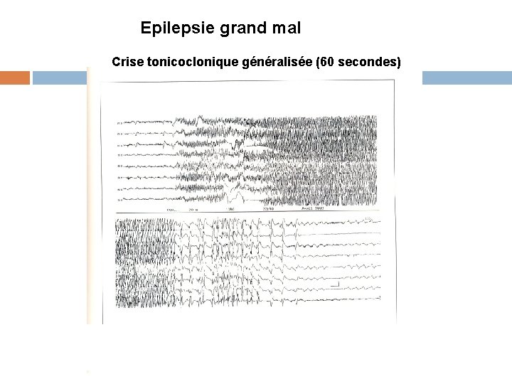 Epilepsie grand mal Crise tonicoclonique généralisée (60 secondes) 