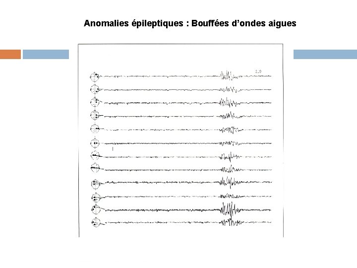 Anomalies épileptiques : Bouffées d’ondes aigues 