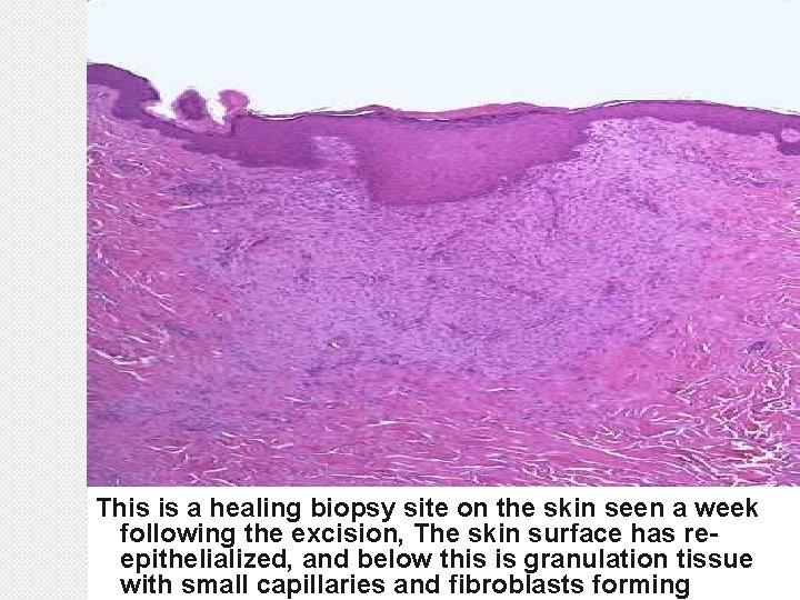 This is a healing biopsy site on the skin seen a week following the