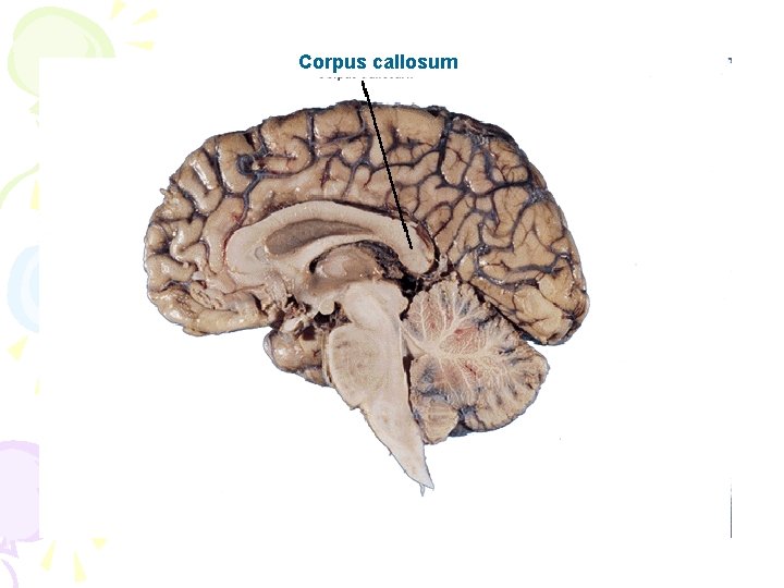 Corpus callosum 
