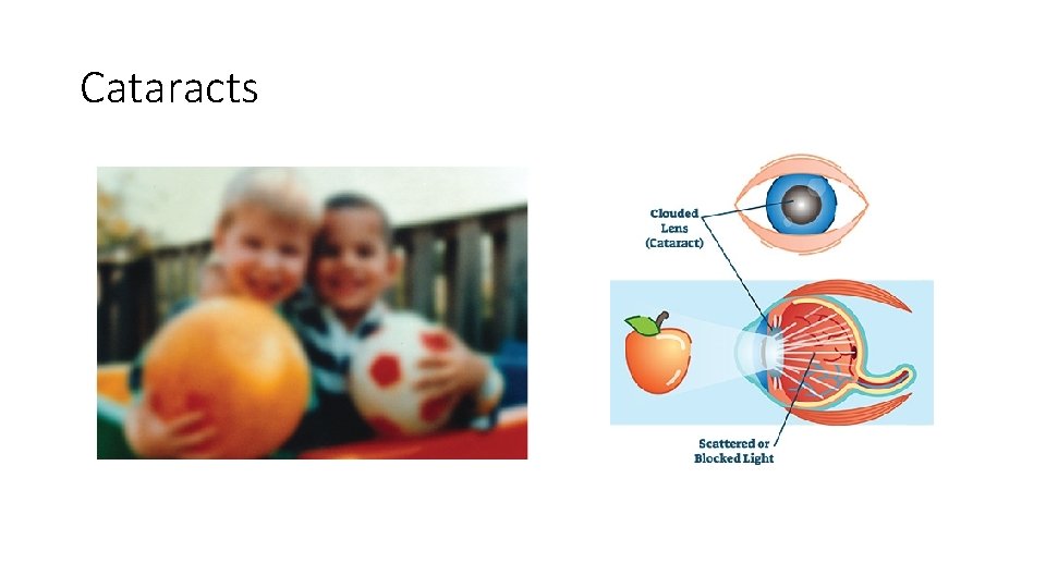 Cataracts 