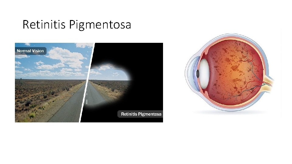 Retinitis Pigmentosa 