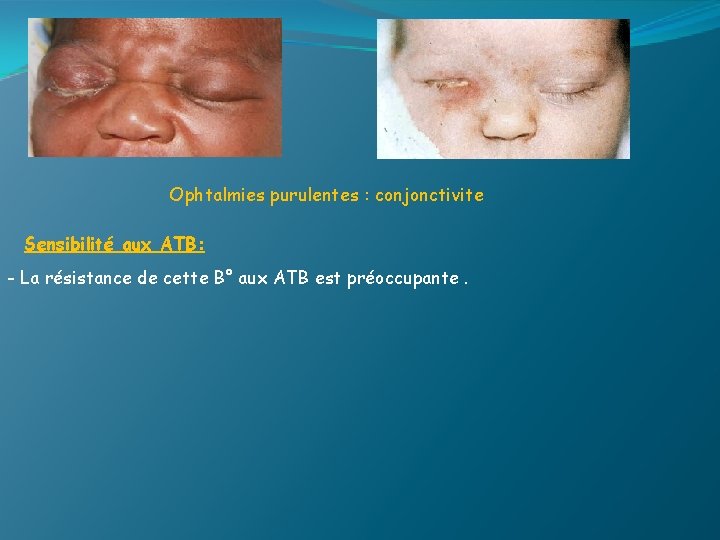 Ophtalmies purulentes : conjonctivite Sensibilité aux ATB: - La résistance de cette B° aux