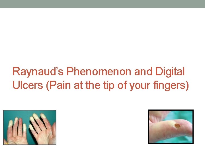 Raynaud’s Phenomenon and Digital Ulcers (Pain at the tip of your fingers) 