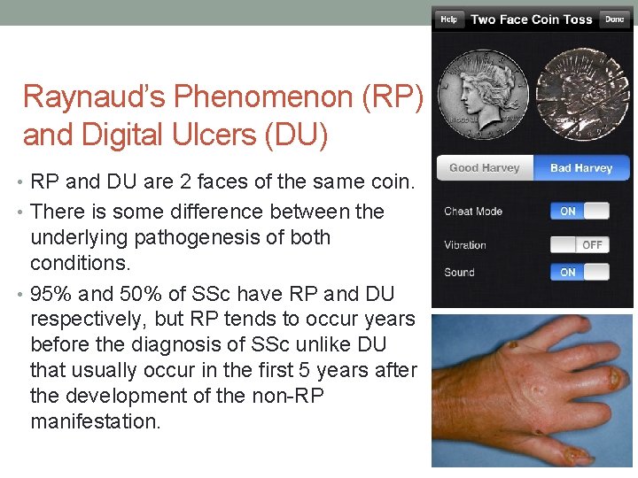 Raynaud’s Phenomenon (RP) and Digital Ulcers (DU) • RP and DU are 2 faces