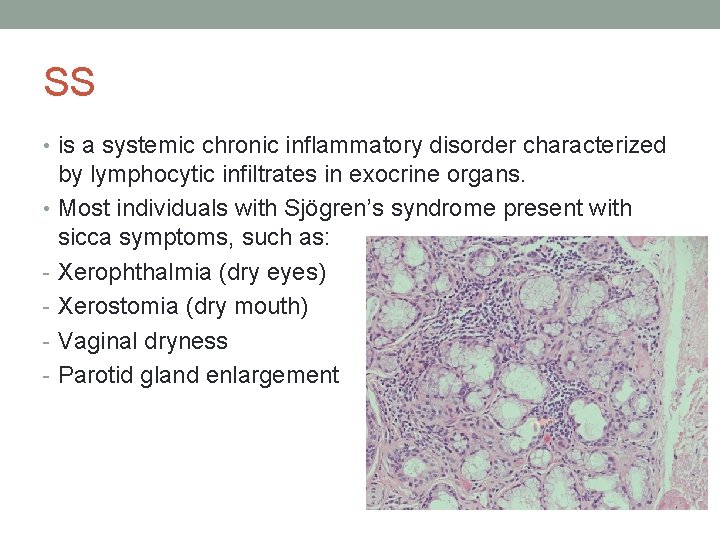 SS • is a systemic chronic inflammatory disorder characterized by lymphocytic infiltrates in exocrine