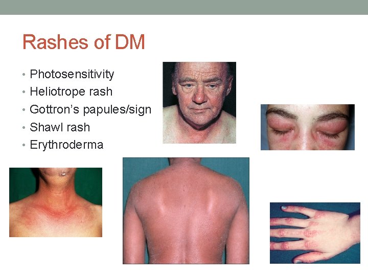 Rashes of DM • Photosensitivity • Heliotrope rash • Gottron’s papules/sign • Shawl rash