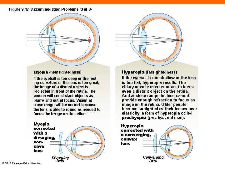 Figure 9 -17 Accommodation Problems (3 of 3) Myopia (nearsightedness) If the eyeball is