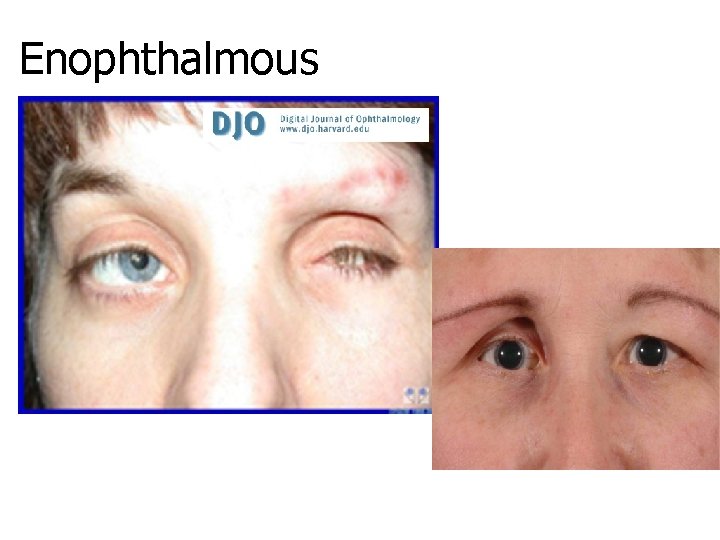 Enophthalmous 