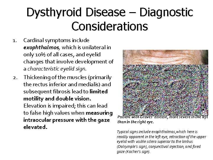 Dysthyroid Disease – Diagnostic Considerations 1. 2. Cardinal symptoms include exophthalmos, which is unilateral