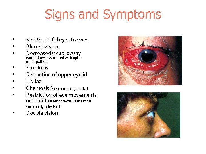 Signs and Symptoms • • • Red & painful eyes (exposure) Blurred vision Decreased