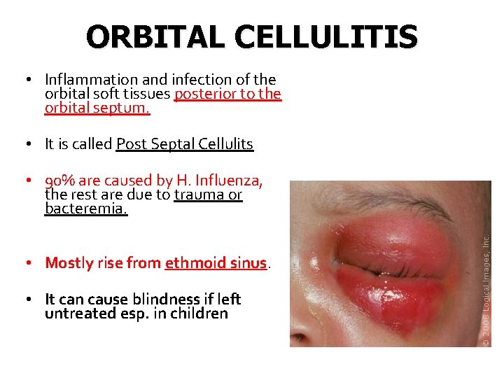 ORBITAL CELLULITIS • Inflammation and infection of the orbital soft tissues posterior to the