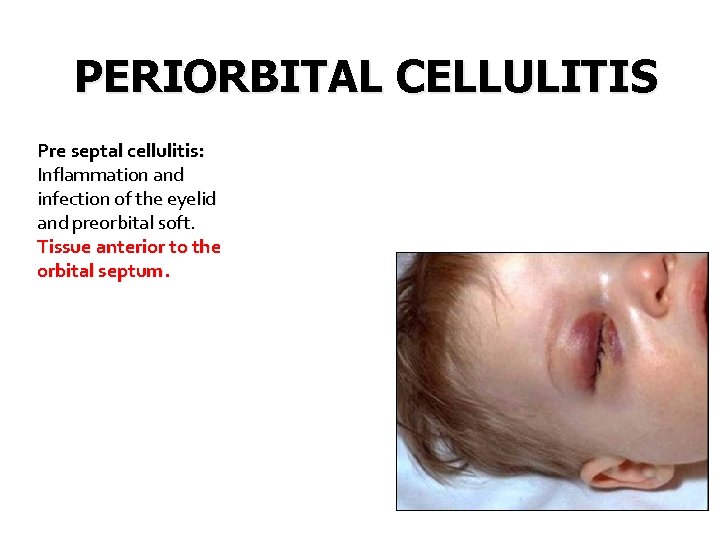 PERIORBITAL CELLULITIS Pre septal cellulitis: Inflammation and infection of the eyelid and preorbital soft.