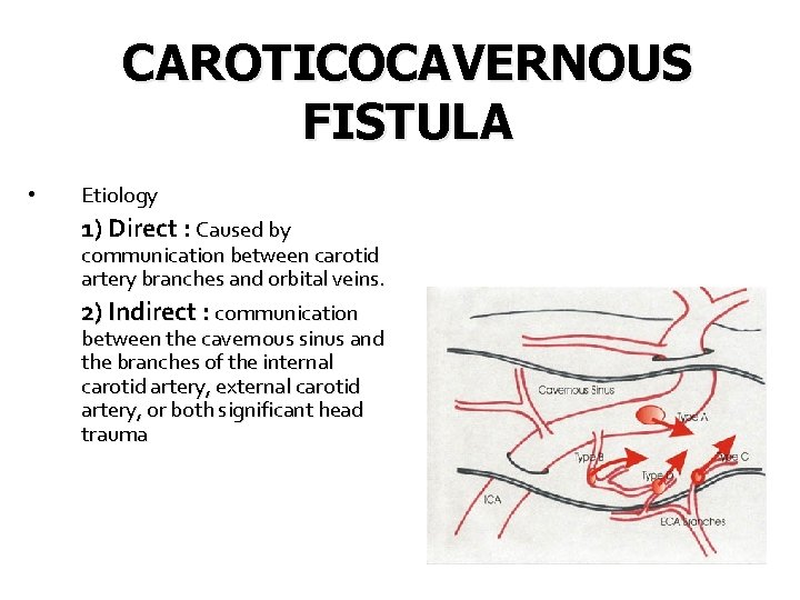 CAROTICOCAVERNOUS FISTULA • Etiology 1) Direct : Caused by communication between carotid artery branches