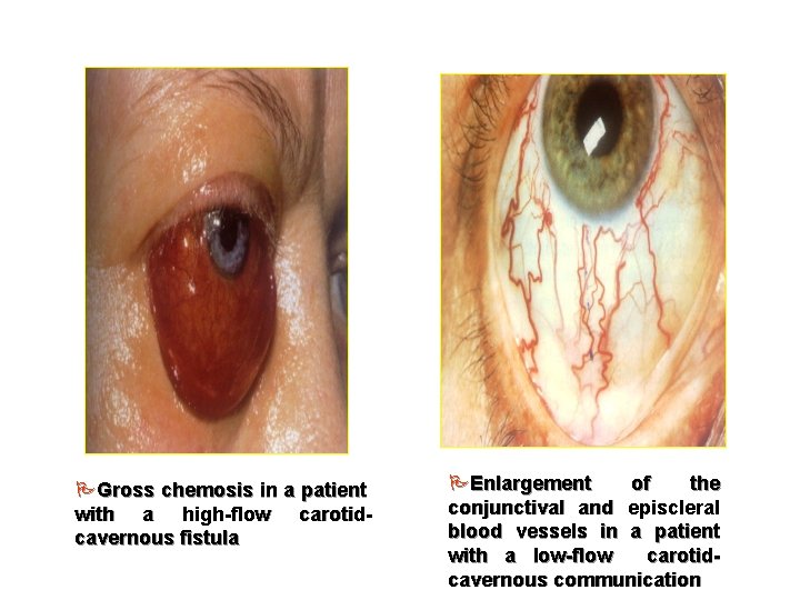 PGross chemosis in a patient with a high-flow carotidcavernous fistula PEnlargement of the conjunctival