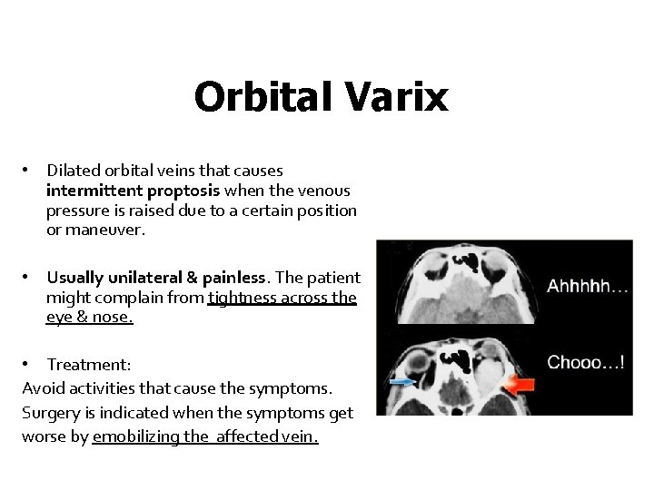 Orbital Varix • Dilated orbital veins that causes intermittent proptosis when the venous pressure