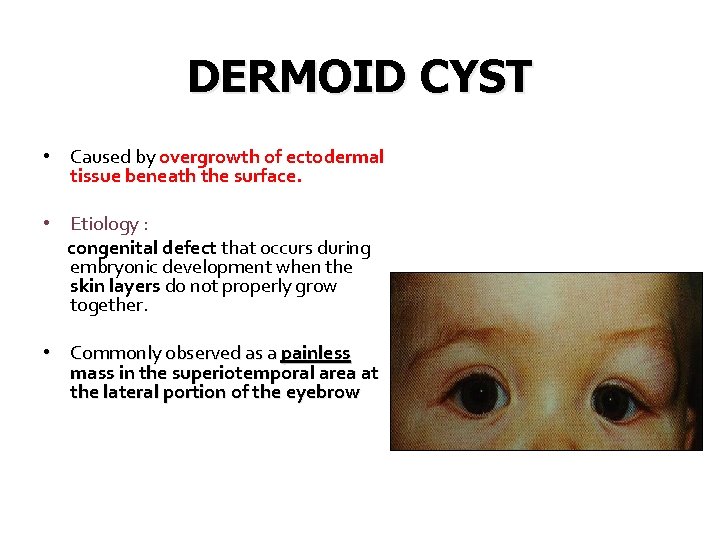 DERMOID CYST • Caused by overgrowth of ectodermal tissue beneath the surface. • Etiology
