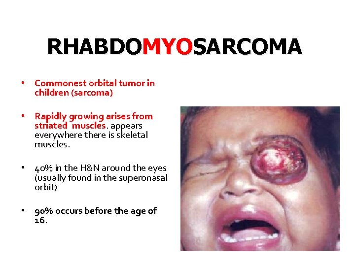 RHABDOMYOSARCOMA • Commonest orbital tumor in children (sarcoma) • Rapidly growing arises from striated
