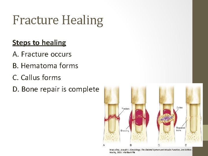 Fracture Healing Steps to healing A. Fracture occurs B. Hematoma forms C. Callus forms