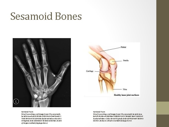 Sesamoid Bones Retrieved from: http: //www. bing. com/images/search? q=sesamoid+ bone&view=detailv 2&&id=D 31829 A 9