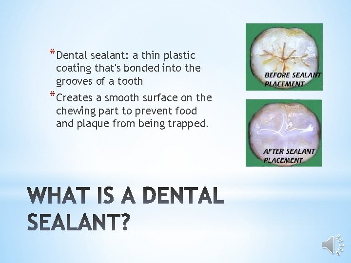 *Dental sealant: a thin plastic coating that's bonded into the grooves of a tooth