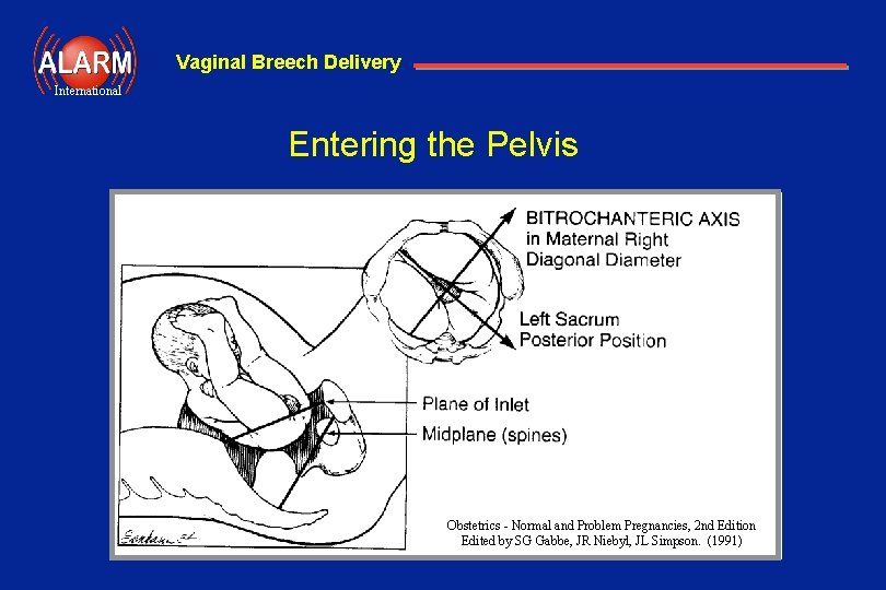 Vaginal Breech Delivery International Entering the Pelvis Obstetrics - Normal and Problem Pregnancies, 2