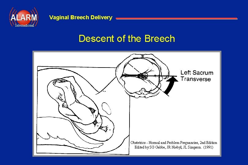 Vaginal Breech Delivery International Descent of the Breech Obstetrics - Normal and Problem Pregnancies,