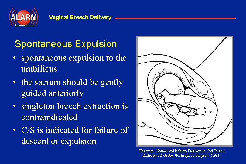 Vaginal Breech Delivery International Spontaneous Expulsion • spontaneous expulsion to the umbilicus • the