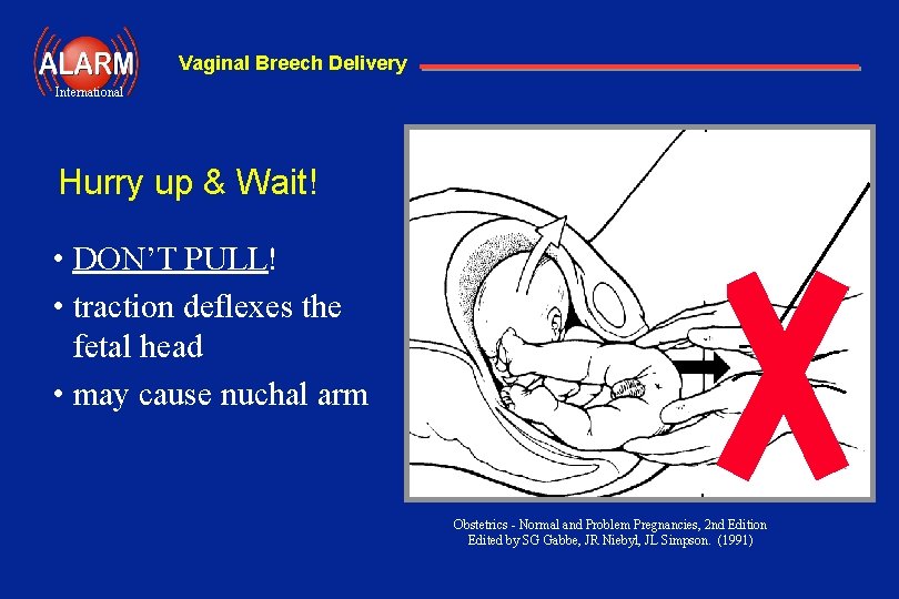 Vaginal Breech Delivery International Hurry up & Wait! • DON’T PULL! • traction deflexes