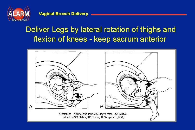 Vaginal Breech Delivery International Deliver Legs by lateral rotation of thighs and flexion of