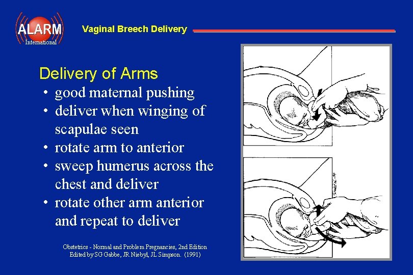 Vaginal Breech Delivery International Delivery of Arms • good maternal pushing • deliver when