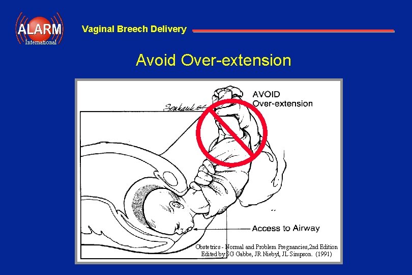 Vaginal Breech Delivery International Avoid Over-extension Obstetrics - Normal and Problem Pregnancies, 2 nd