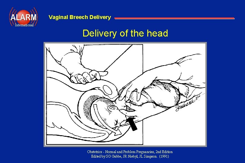 Vaginal Breech Delivery International Delivery of the head Obstetrics - Normal and Problem Pregnancies,