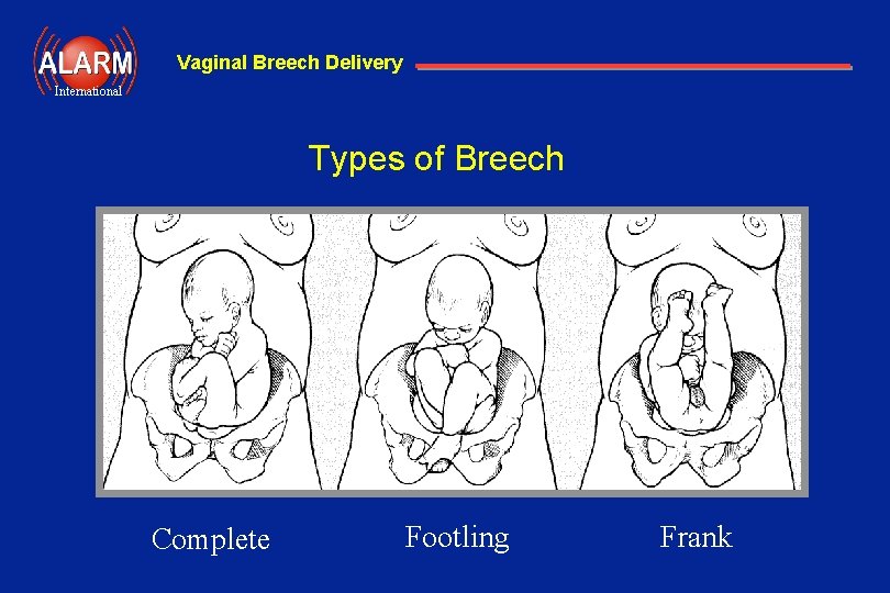 Vaginal Breech Delivery International Types of Breech Complete Footling Frank 