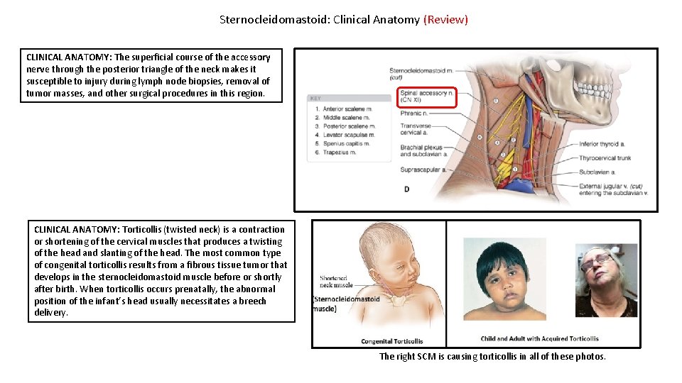 Sternocleidomastoid: Clinical Anatomy (Review) CLINICAL ANATOMY: The superficial course of the accessory nerve through