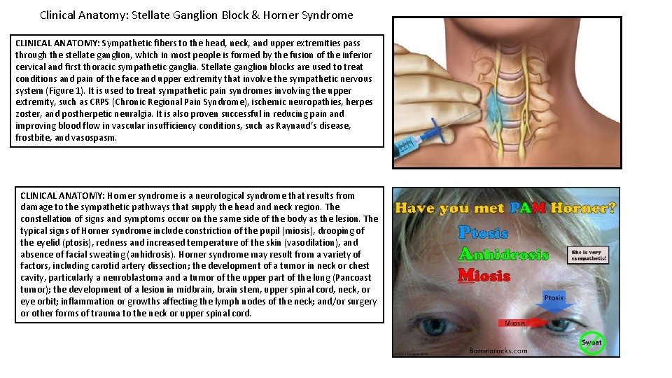 Clinical Anatomy: Stellate Ganglion Block & Horner Syndrome CLINICAL ANATOMY: Sympathetic fibers to the