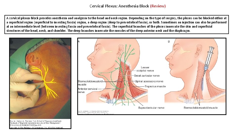 Cervical Plexus: Anesthesia Block (Review) A cervical plexus block provides anesthesia and analgesia to
