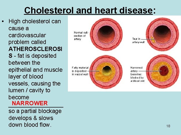 Cholesterol and heart disease: • High cholesterol can cause a cardiovascular problem called ATHEROSCLEROSI