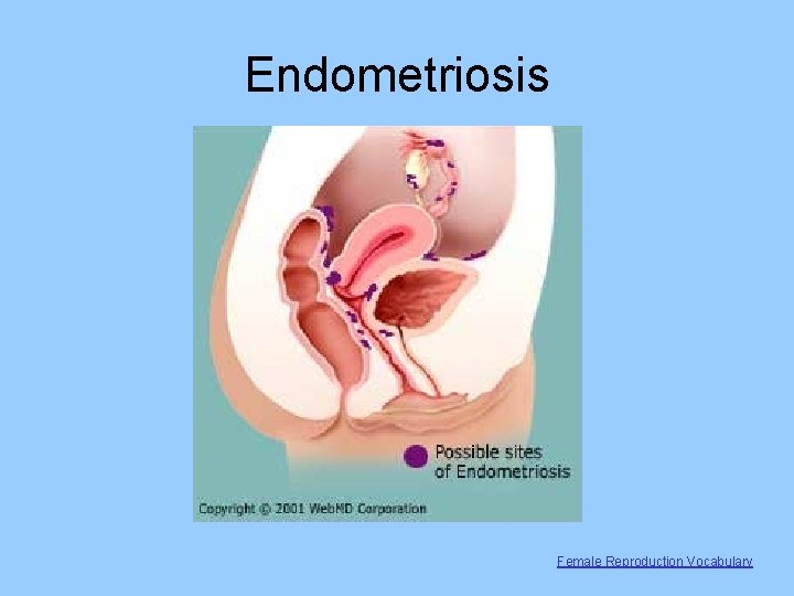 Endometriosis Female Reproduction Vocabulary 