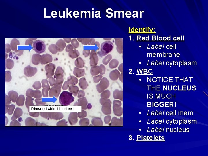 Leukemia Smear Diseased white blood cell Identify: 1. Red Blood cell • Label cell